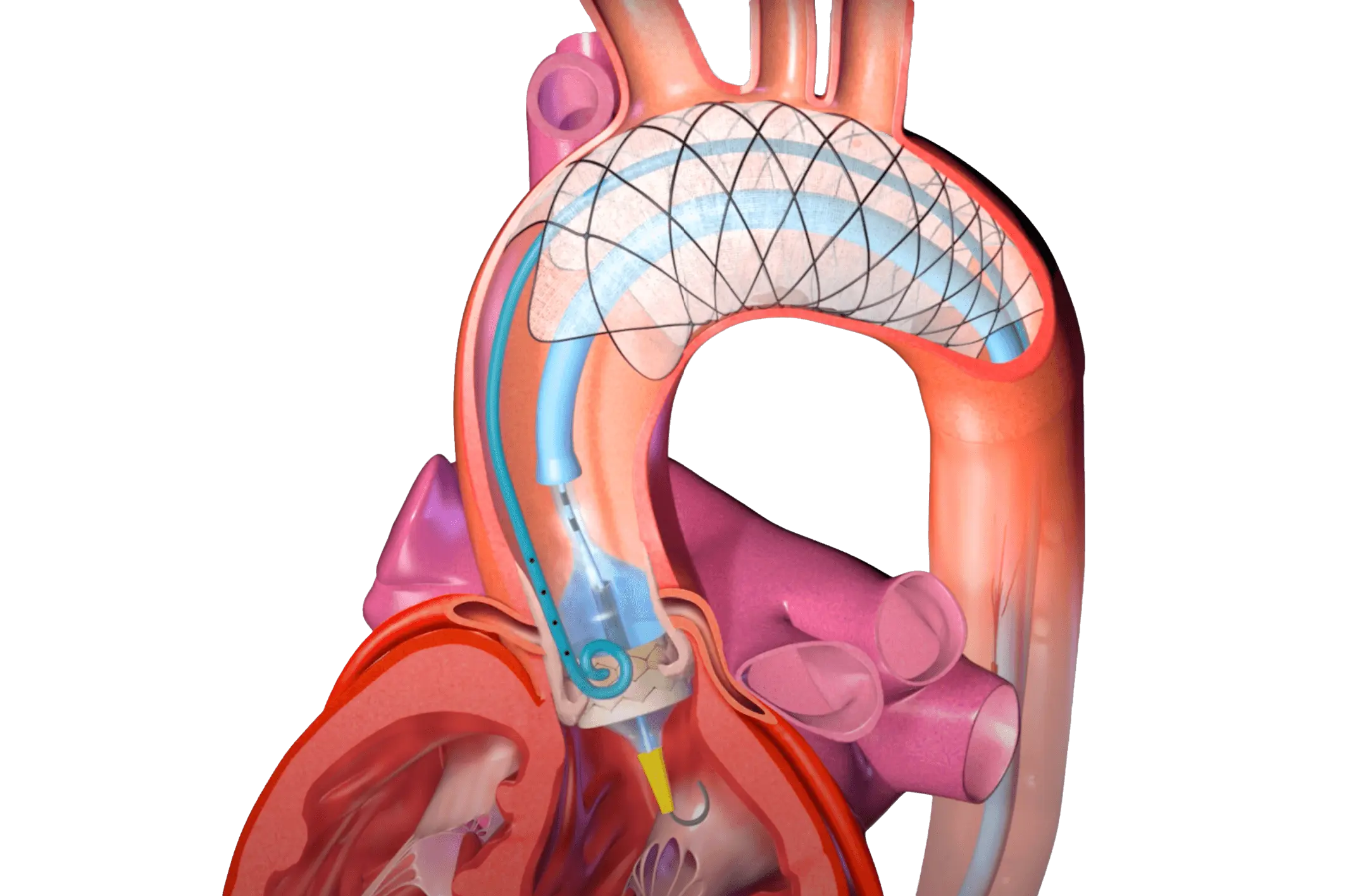 animated heart with filtration device