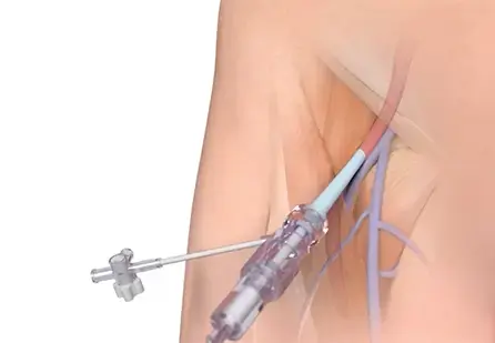 self-expanding and low-profile design offers unmatched ease to insert, deploy, and retrieve, through either femoral artery.